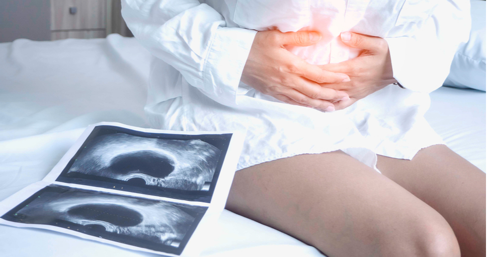 Endometriosis: los múltiples efectos del dolor ginecológico