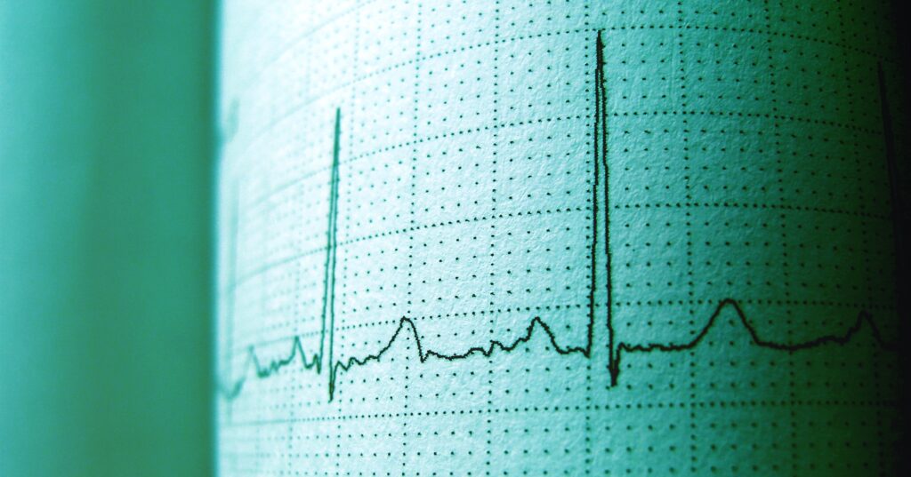 Qué es la insuficiencia cardíaca, cuáles son sus síntomas y cómo evitarla