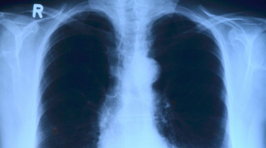 Para los que tengan enfermedades respiratorias: ¿Qué hacer con la vacuna Covid?