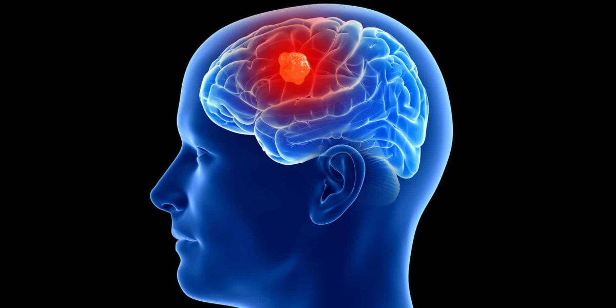 Día Internacional de los Tumores Cerebrales ¿Cuáles son los signos de la presencia de un tumor?
