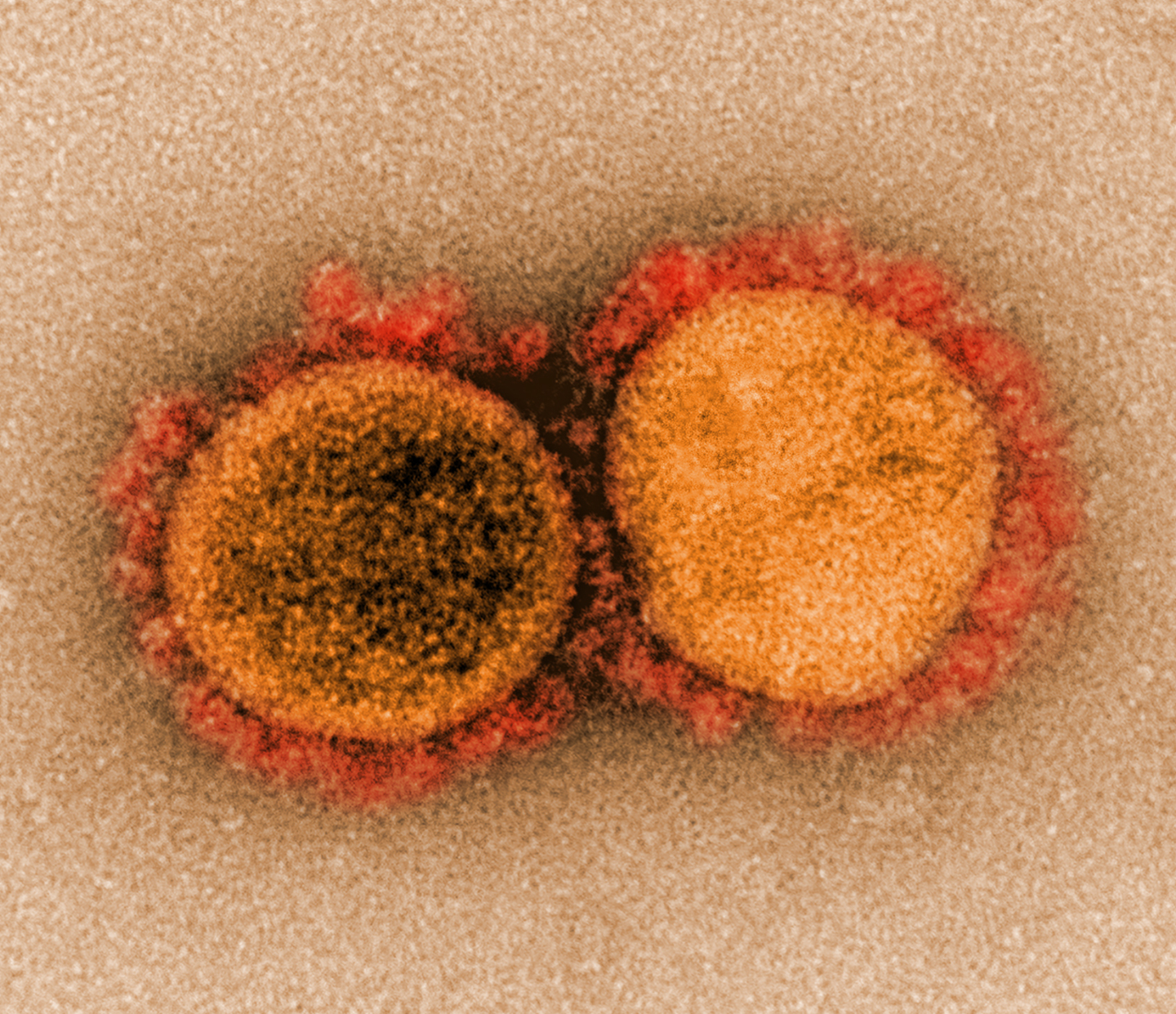 Los «secretos» de la variante Delta: </br>es un «monstruo» al lado del coronavirus de Wuhan