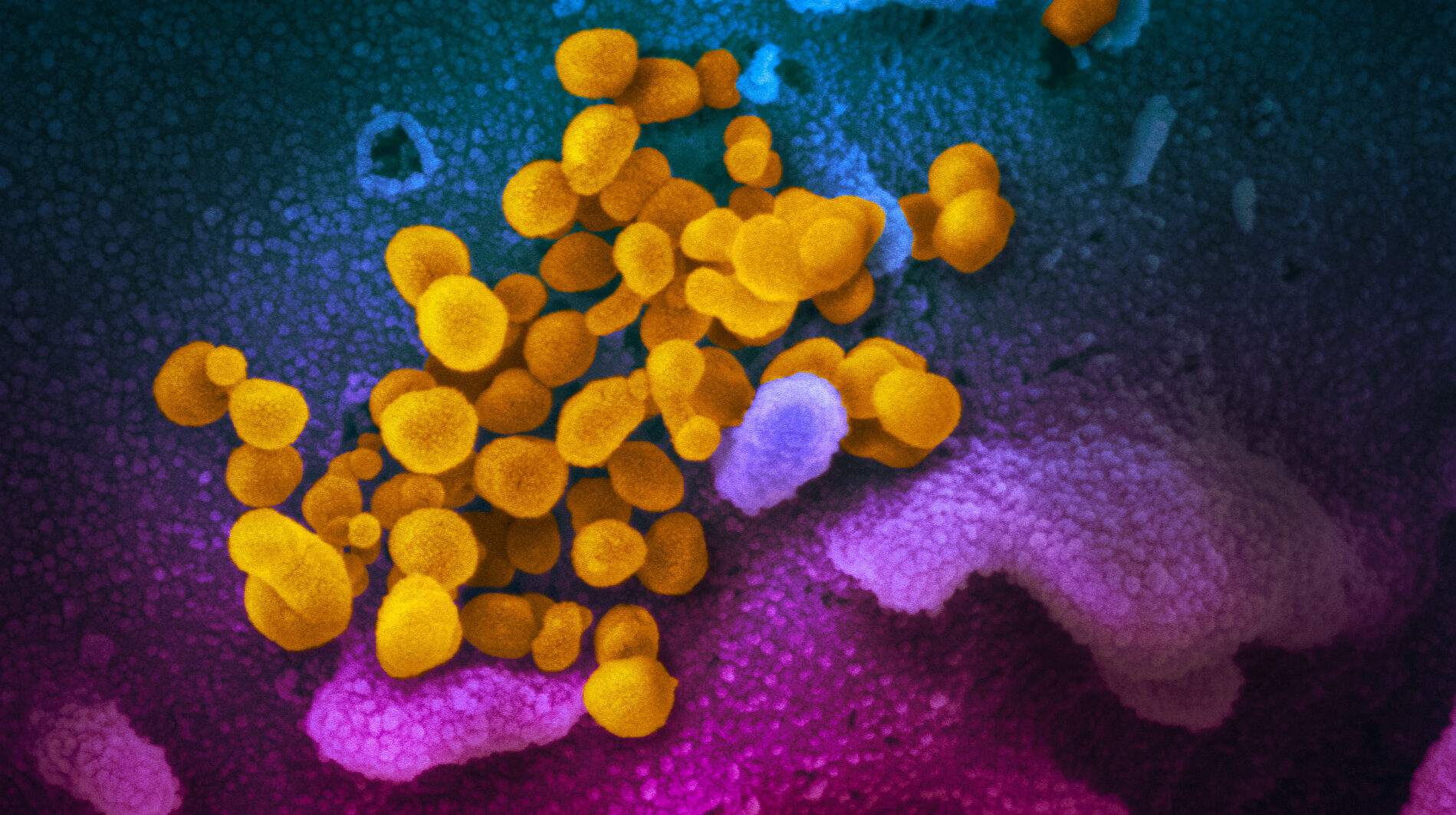 «Superinmunidad»: el gran misterio de la pandemia del coronavirus