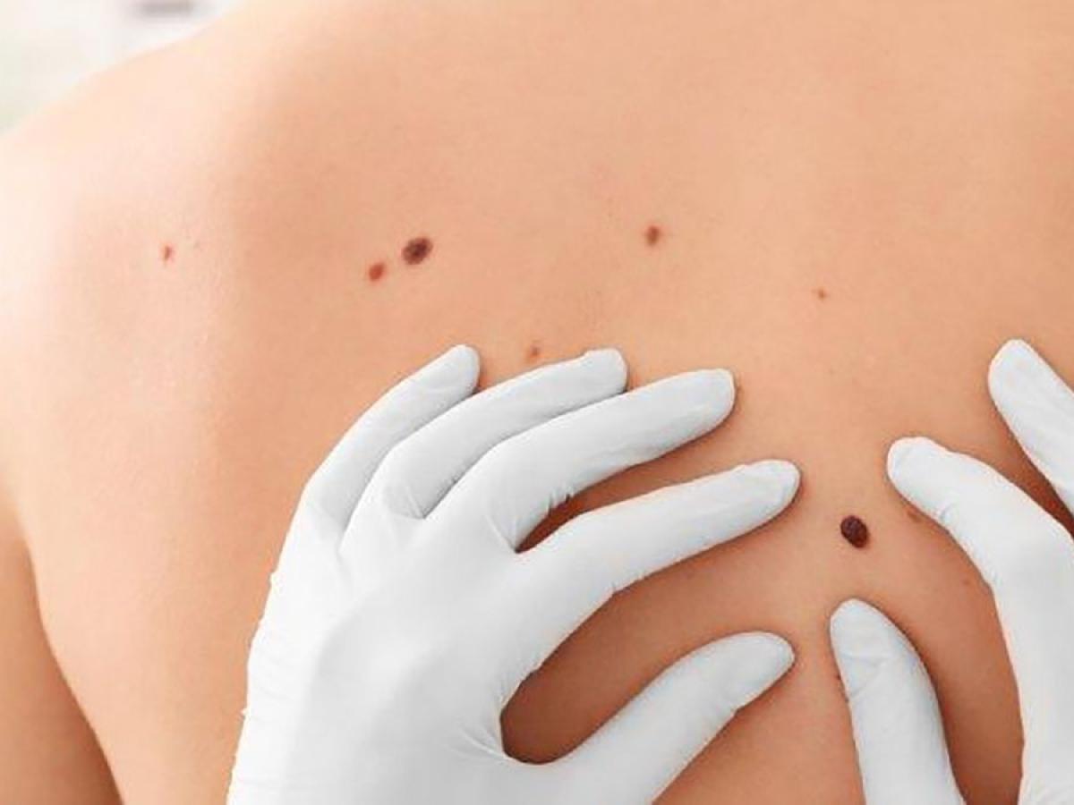 Desarrollan una vacuna con la que prevenir el cáncer de piel